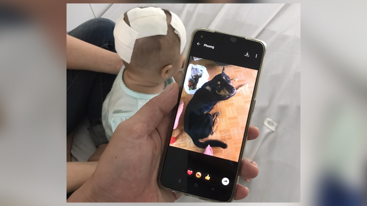 Nghịch thú cưng, bé gái 6 tháng tuổi bị chó cắn xuyên xương sọ